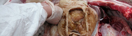 Stomach ulcers