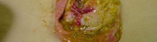 Úlcera en la zona pilórica