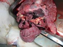 Endocarditis "en coliflor"