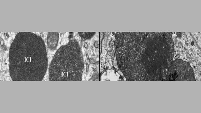 Microscopía electrónica de un linfonodo de un cerdo con PCV2-ES
