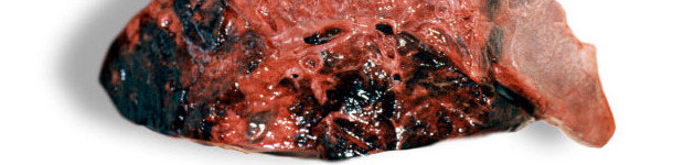 Lesiones hemorrágicas en el parénquima pulmonar
