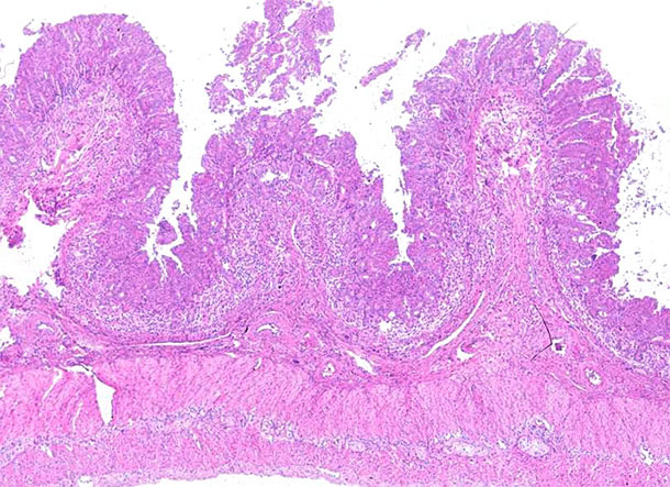 Íleon. Depleción de linfocitos marcada y inflamación granulomatosa de las placas de Peyer en el íleon de un cerdo afectado por enfermedad sistémica asociada a PCV2. Tinció de hematoxilina y eosina.