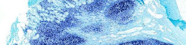 Íleon. El mismo íleon del cerdo afectado por enfermedad sistémica asociada a PCV2 presenta una gran cantidad de genoma de PCV2 en las placas de Peyer y en la mucosa intestinal. Hibridación in situ para detectar PCV2; colorante de contraste verde rápido.