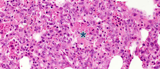 Restos necróticos intraalveolares y acumulación de células inflamatorias (asterisco) en el tejido pulmonara los 10 días PI con un aislado de PRRSV tipo 1 subtipo 1