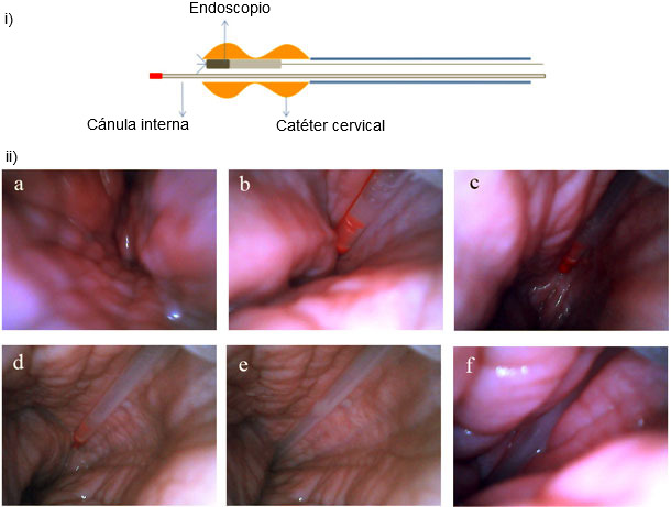 Inseminación post-cervical vista desde el interior del útero