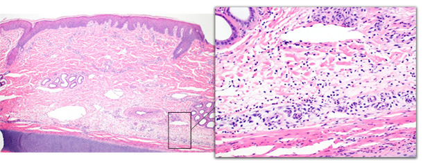 Biopsia de la punta de la oreja de un cerdo con una afectación aguda. La dermis profunda está expandida por un edema y hay un número moderado de neutrófilos con cambios epidérmicos mínimos