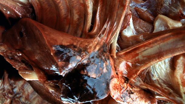 Pleuritis fibrinosa organizada tras una exposición a Acpp