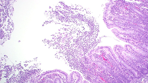 Colitis ulcerativa fibrinopurulenta multifocal o localmente extensa.
