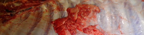 Pleuritis en pulmones