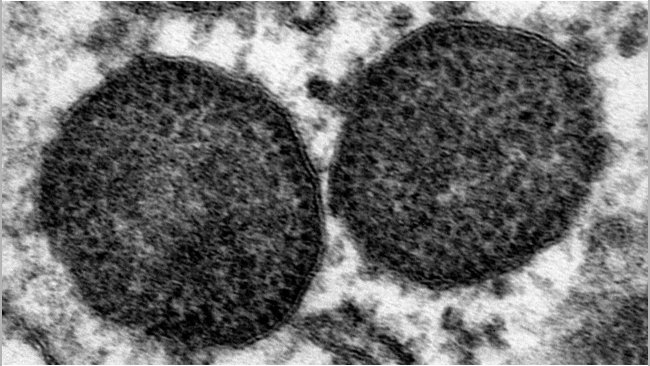 Microfotografía electrónica de dos cuerpos de inclusión en el citoplasma de un macrófago, que incluyen un muy elevado número de partículas de PCV2. 150.000x. Fuente: Carolina Rodríguez-Cariño, CReSA