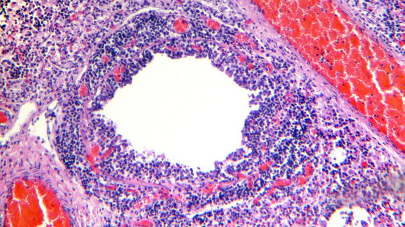 Figura 4. Bronquiolo que muestra descamaci&oacute;n y necrosis del epitelio respiratorio, junto con una marcada infiltraci&oacute;n linfoc&iacute;tica de la l&aacute;mina propia y submucosa.
