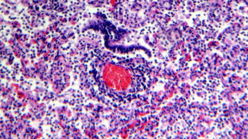 Figura 5. Infiltrado linfocitario perivascular.
