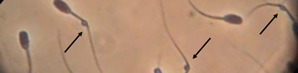 Anomalías del semen