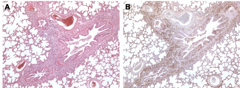 Figura 3. Pulm&oacute;n de un cerdo coinfectado por M. hyopneumoniae y PCV2. A: &Aacute;rea de hiperplasia linfoide peribronquiolar causada por M. hyopneumoniae. B: Gran cantidad de ant&iacute;geno de PCV2 en esa misma &aacute;rea de hiperplasia linfoide.
