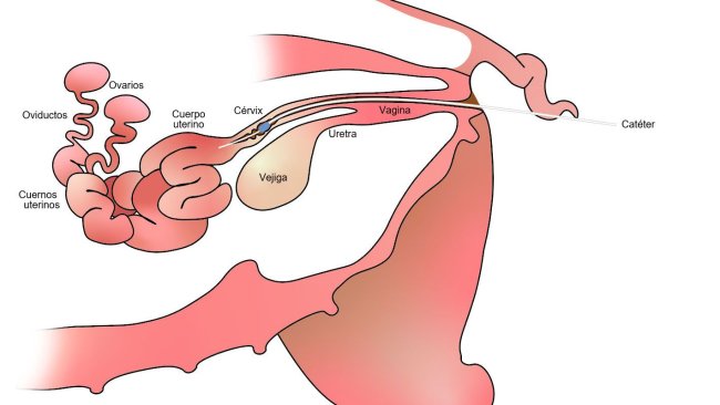 Imagen 1. En la inseminación artificial postcervial el semen se deposita en el cuerpo del útero, después del cérvix.