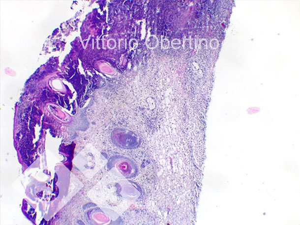 Figura 9. Piel. Erosi&oacute;n epitelial focal en la que la capa superficial es reemplazada por abundante material eosinof&iacute;lico amorfo a granular con restos carior&eacute;cticos (necrosis) y abundantes granulocitos neutrof&iacute;licos degenerados y viables. Multifocalmente, el epitelio aparece de moderada a marcadamente hiperpl&aacute;sica con hiperqueratosis ortoquerat&oacute;sica de moderada a severa. Tambi&eacute;n se observa presencia multifocal de costras. La dermis aparece difusa y moderadamente fibr&oacute;tica.
