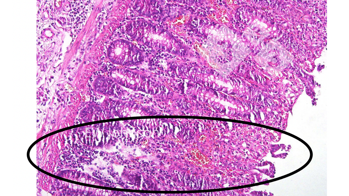 <p>Foto 4. Trombosis vascular, infarto, ulceraci&oacute;n en mucosa del colon.</p>
