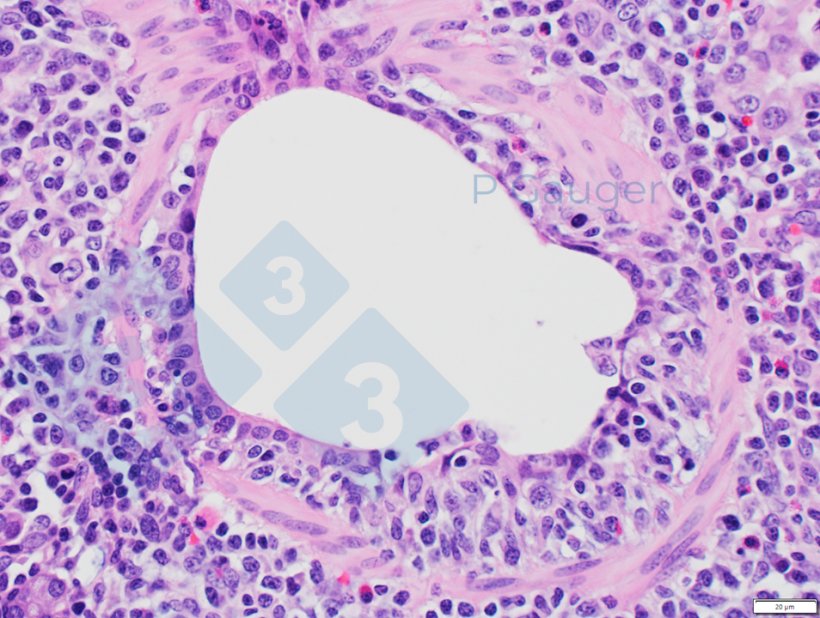 Figura 4: Histopatolog&iacute;a pulmonar que muestra el adelgazamiento del epitelio bronquiolar, que es un ejemplo de necrosis.&nbsp;(Fuente de la foto: Phil Gauger ISUVDL)
