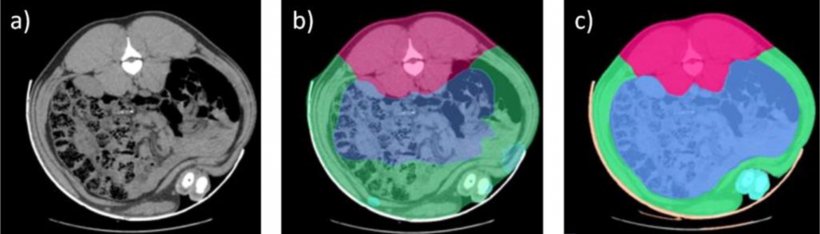Figura 1. Imágenes de TC, a) sin segmentación, b) segmentación previa a implementación de IA, c) con correcciones manuales de los segmentos usados durante el proceso de entrenamiento de la IA. El área rosa corresponde al lomo, azul a los intestinos, y verde a la pared abdominal, en turquesa aparece segmento de la extremidad.