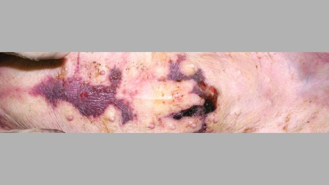 Accumulation de liquide sous la peau dans la région sternale