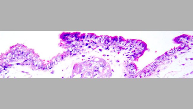 Nécrose coagulante sur les trophoblastes Coloration hématoxyline-éosine