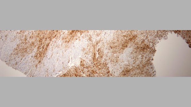 Lésion myocardique sévère due au PCV2