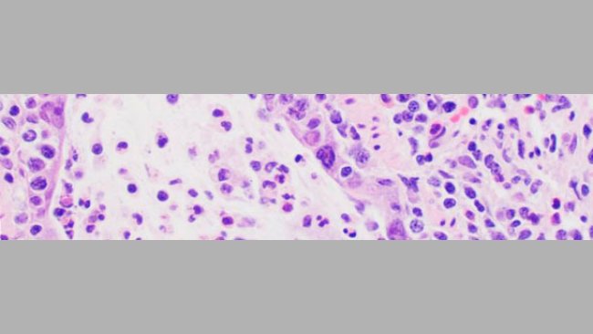 Lesiones microscópicas compatibles con la infección por influenza, incluyen necrosis del epitelio bronquiolar donde el virus se replica