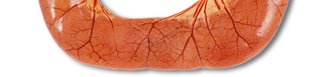 L&rsquo;autopsie de cas de diarrh&eacute;e par ETEC montre souvent des anses de l&rsquo;intestin gr&ecirc;le dilat&eacute;es, fines et congestionn&eacute;es, remplies de diarrh&eacute;e aqueuse de couleur jaune