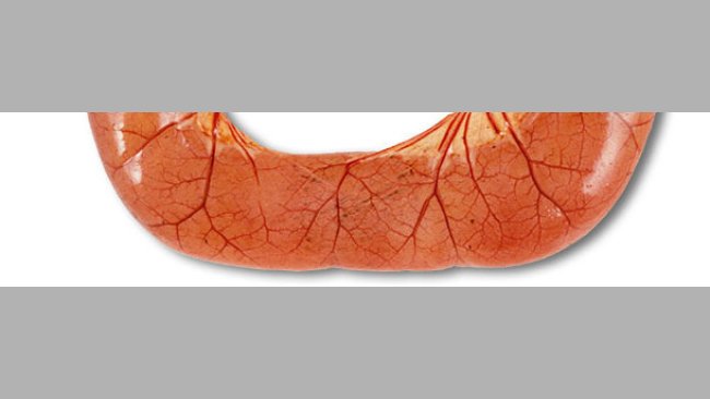 L’autopsie de cas de diarrhée par ETEC montre souvent des anses de l’intestin grêle dilatées, fines et congestionnées, remplies de diarrhée aqueuse de couleur jaune