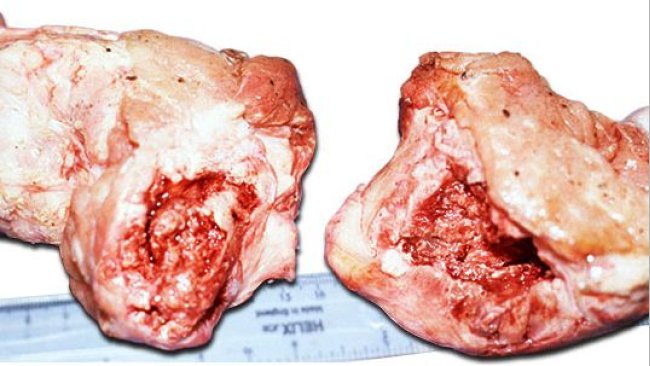 Tête de fémur complètement fracturée au niveau ou sous l’épiphyse montrant un gonflement autour de la fracture due à une périostite.