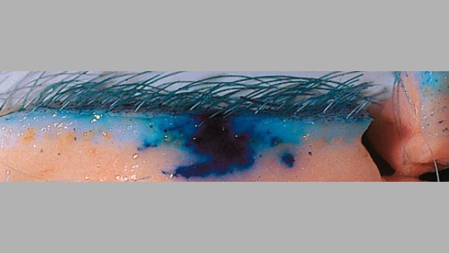 La technologie sans aiguille améliore la dispersion des vaccins dans les tissus.