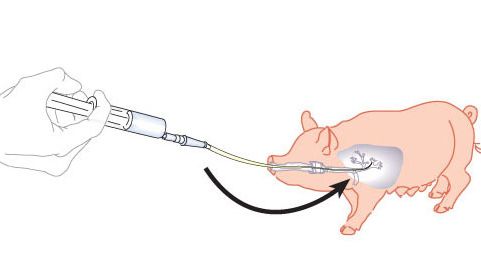 Figure&nbsp;1. Sch&eacute;ma du lacvage boncho-alv&eacute;olaire et du curetage bronchique
