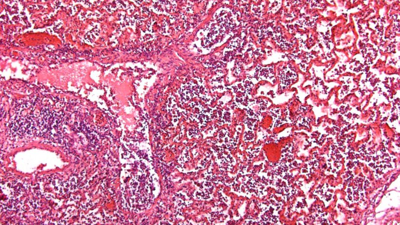Figure 5. Alv&eacute;oles avec accumulation de liquide et cellules inflammatoires
