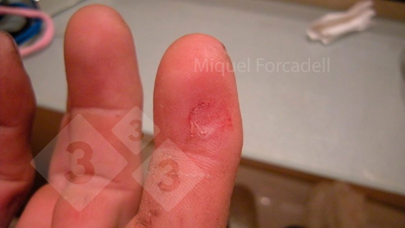 Les petits crocs ac&eacute;r&eacute;s des porcelets peuvent provoquer ces blessures g&ecirc;nantes sur les doigts des op&eacute;rateurs lors du limage des dents.
