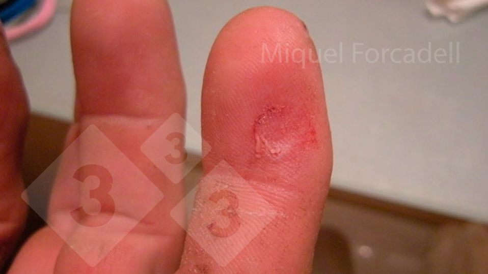 Les petits crocs ac&eacute;r&eacute;s des porcelets peuvent provoquer ces blessures g&ecirc;nantes sur les doigts des op&eacute;rateurs lors du limage des dents.
