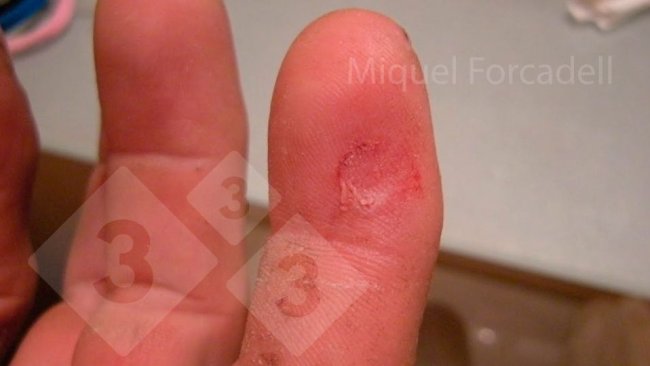 Les petits crocs acérés des porcelets peuvent provoquer ces blessures gênantes sur les doigts des opérateurs lors du limage des dents.