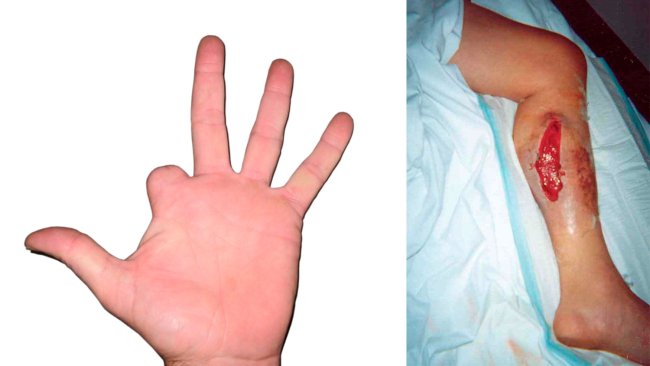 Figure 2 : Ce producteur s'est accidentellement injecté au doigt un vaccin contenant un adjuvant huileux. Il ne s'est pas fait soigner immédiatement et on a dû lui amputer le doigt car l'apport de sang et l'innervation ont été endommagés par l'inflammation. Figure 3 : Injection accidentelle de vaccin. On a dû opérer la jambe pour éliminer le tissu endommagé ainsi que le vaccin et l'adjuvant.