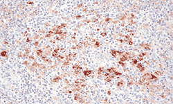 Moderada cantidad de genoma de circovirus porcino tipo 2. Inmunohistoquímica.