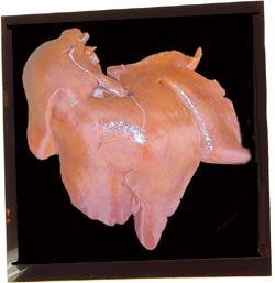 Hígado atrófico. La coloración anaranjada es indicativa de ictericia.