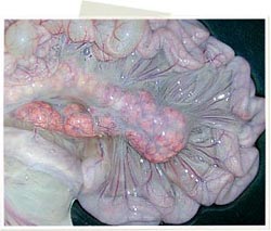 Marcado incremento de tamaño del linfonodo, enrojecimiento y el edema del mesenterio.