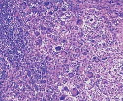Depleción linfocitaria con marcada infiltración por macrófagos y células gigantes multinucleadas