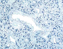 neumonía proliferativa necrotizante masiva presencia de genoma de PCV2