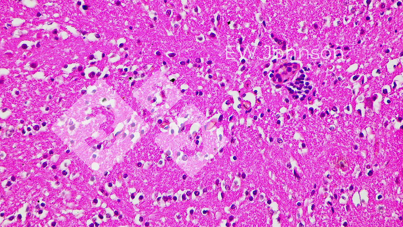 <p>Figura 4.&nbsp;Encefalitis cerebral con vasculitis, satelitosis y neuronofagia.</p>
