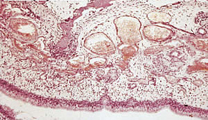 Sección histológica de hocico de cerdo con Rinitis atrófica: resorción ósea con hiperplasia de los osteoclastos y sustitución por tejido fibroso, congestión de los vasos capilares, edema y presencia de una infiltración de la submucosa por células mononucleares.