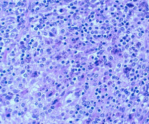 Depleción linfocitaria severa con inflamación granulomatosa del tejido linfoide. Presencia de cuerpos de inclusión intracitoplasmáticos.