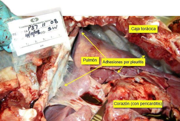 Pericarditis