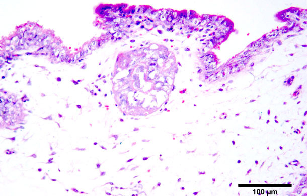 Necrosis coagulativa en trofoblastos. Tinción hematoxilina-eosina. 