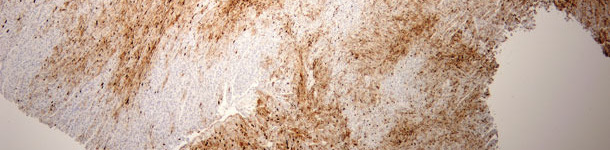 severe myocardial damage due to PCV2