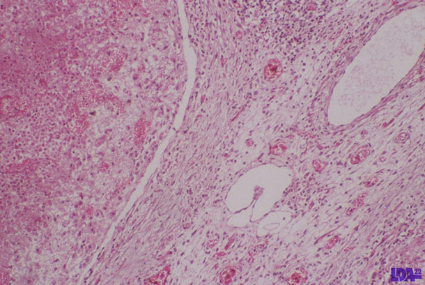 Linfonodo con necrosis en un lechón infectado por PCV2.