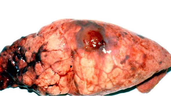 Lesiones de App cr&oacute;nica en el l&oacute;bulo diafragm&aacute;tico con ac&uacute;mulos de fibrina.